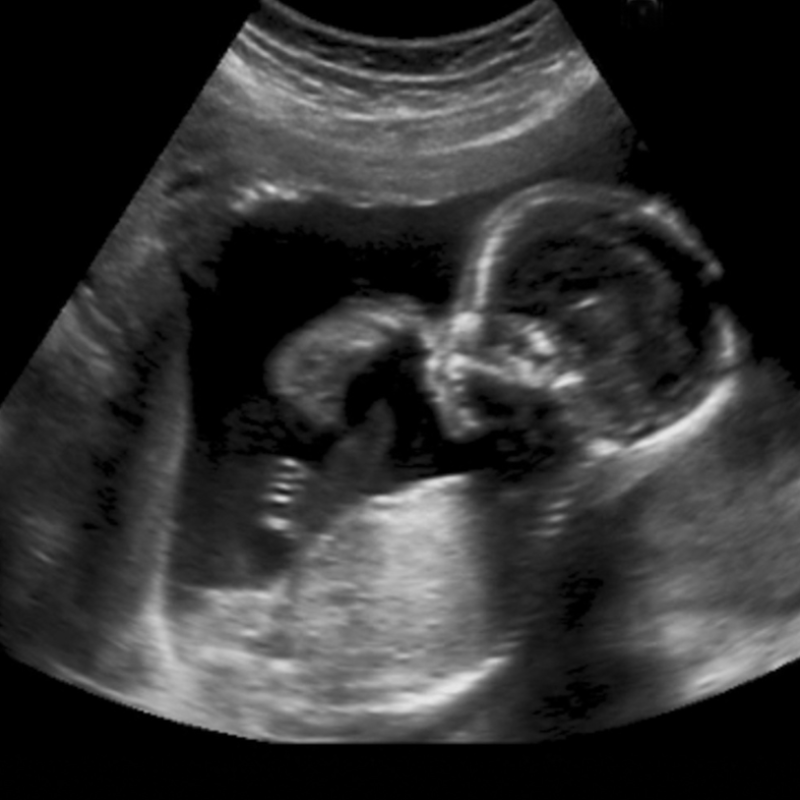 Ultrasound of baby in womb.